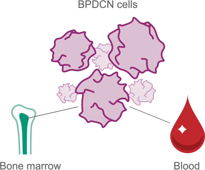 BPDCN cells and how it affects bone marrow and blood