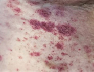 BPDCN discolored, usually flat, skin patches