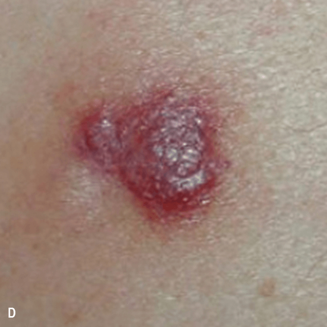 Sign of BPDCN on skin