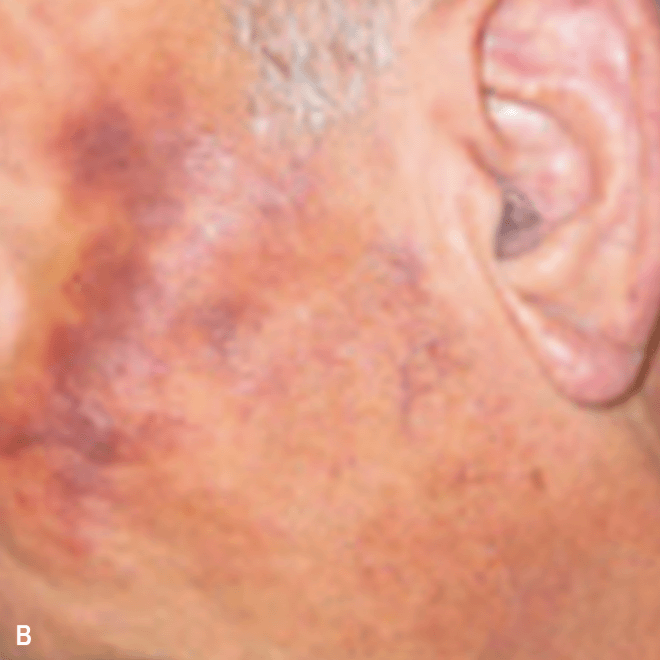 BPDCN skin symptom on face