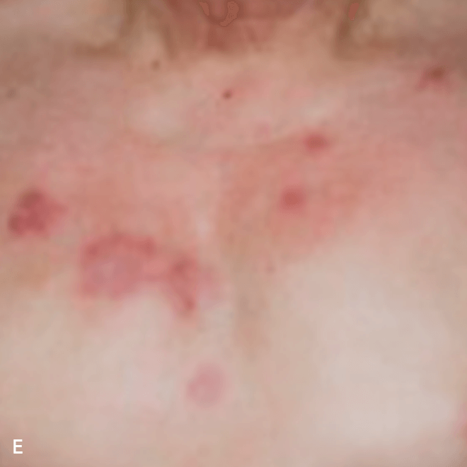 BPDCN symptom on trunk of body