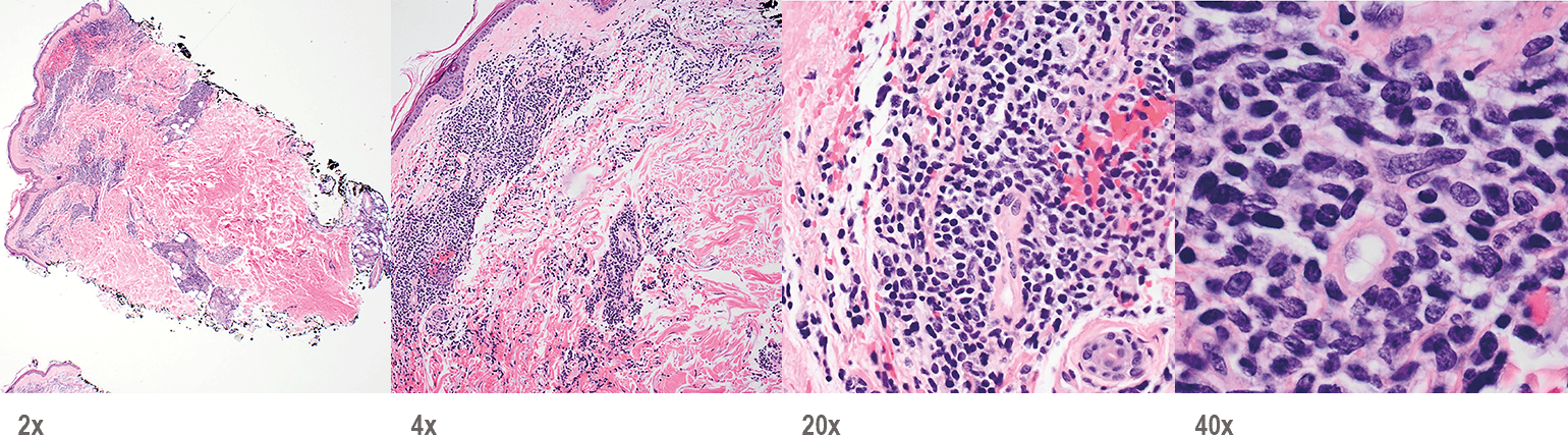 BPDCN with low-density infiltrate