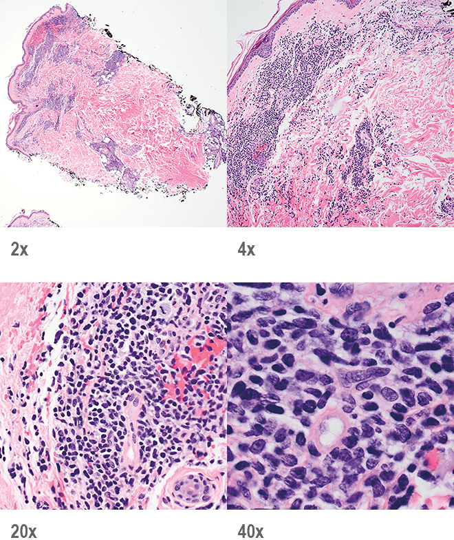 BPDCN with low-density infiltrate