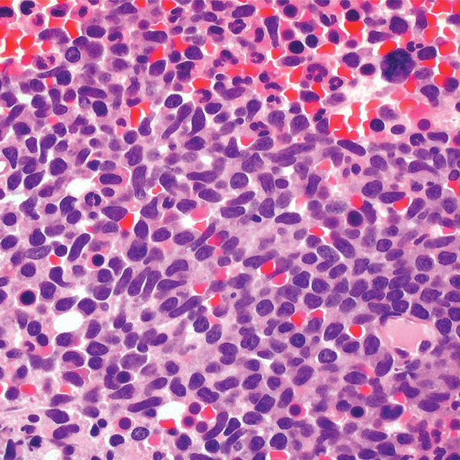 Core bone marrow biopsy