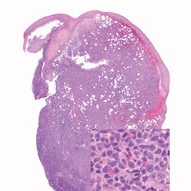 Punch biopsy of a skin lesion showing BPDCN