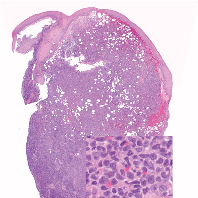 Punch biopsy of a skin lesion showing BPDCN