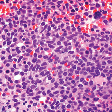 Core bone marrow biopsy